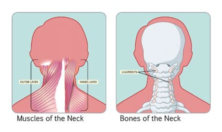 Can a draught cause a stiff neck?