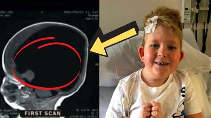 Can a person be brainless?