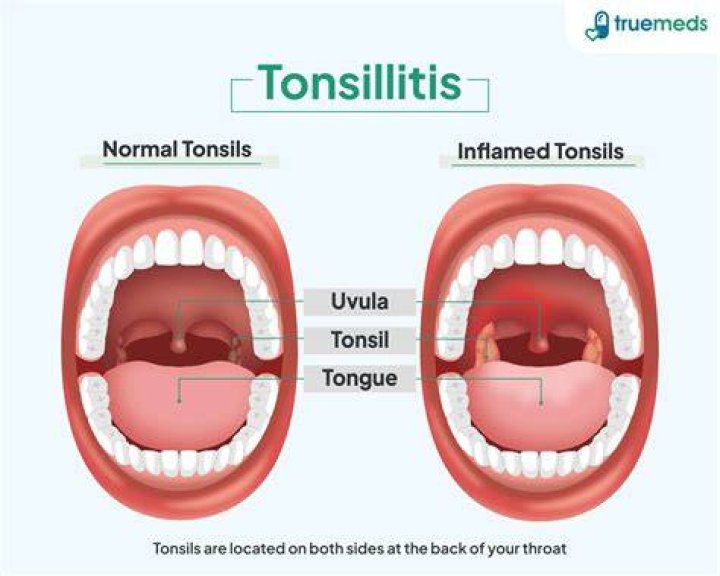Could my tonsils be making me sick?