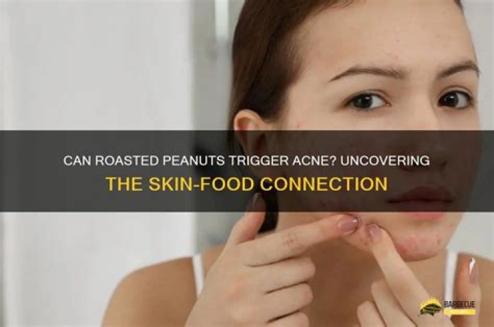 Could peanuts cause acne?