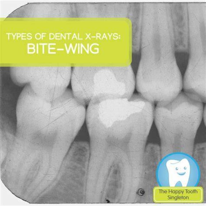 Do bitewings show front teeth?