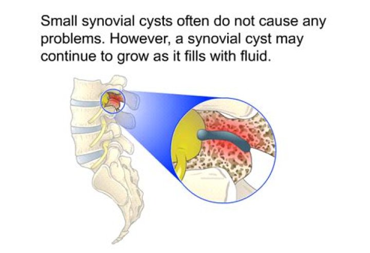 Do synovial cysts go away?
