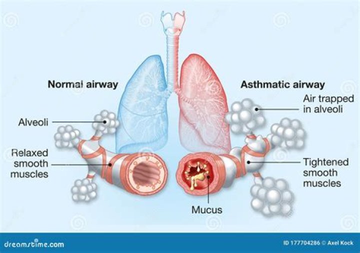 Does asthma affect alveoli?
