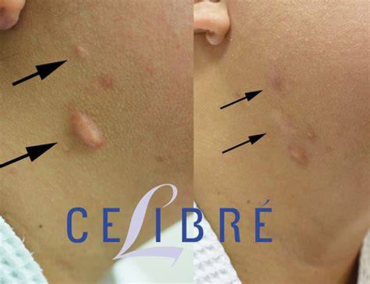 Does emu oil help keloids?