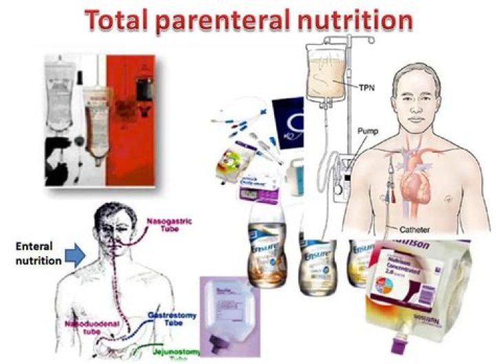 Does parenteral nutrition need a filter?
