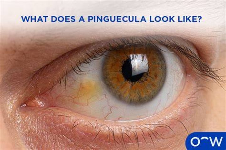 Does pinguecula affect vision?