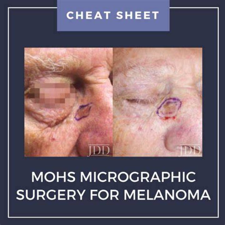 How to code mohs micrographic surgery?