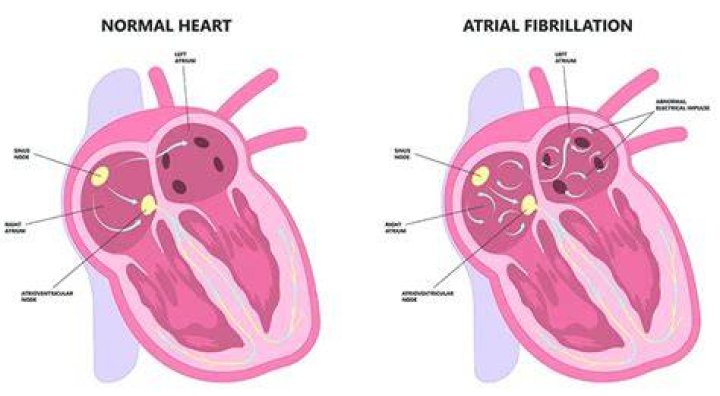 Is having afib dangerous?