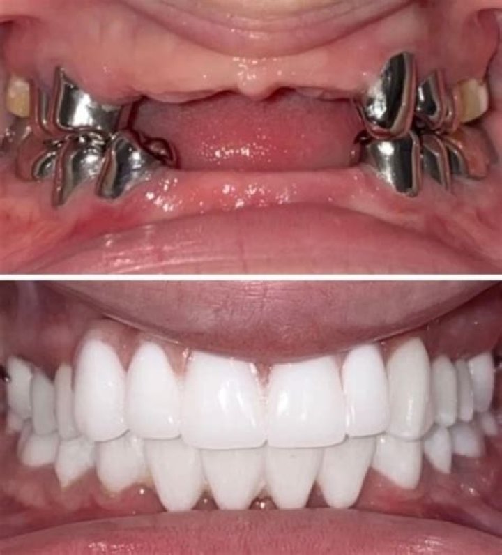 Were gypsy rose teeth removed?