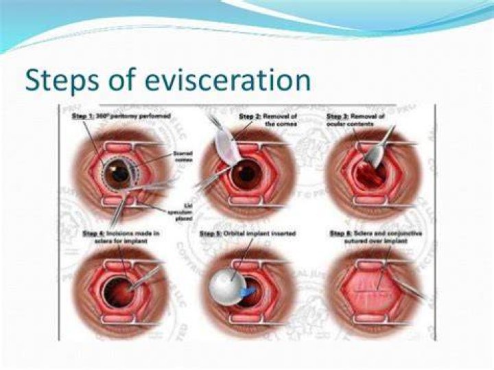 What does evisceration mean?