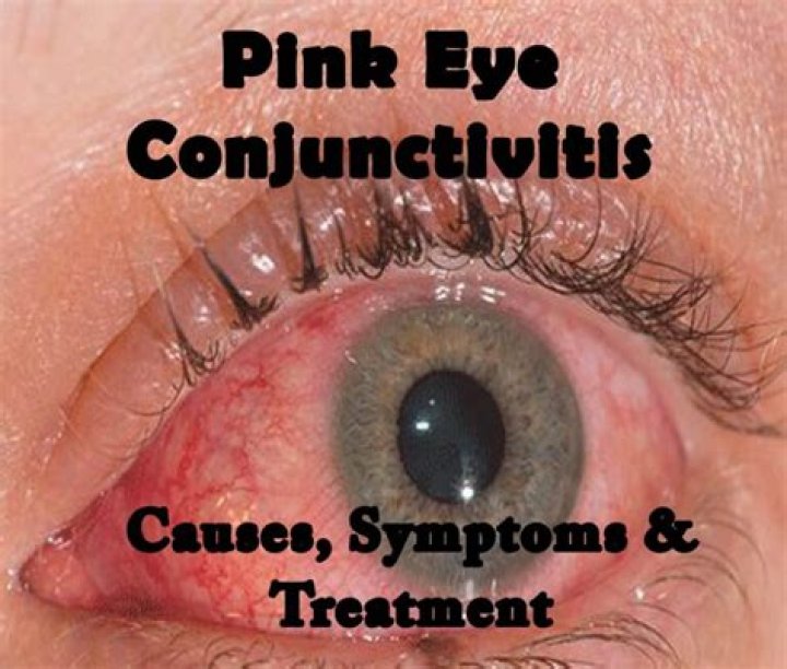 What does pink eye do?