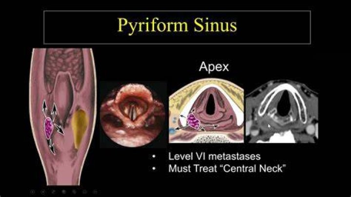 What is pyriform sinus?