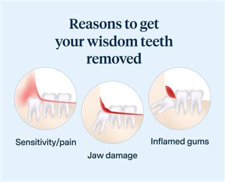 When do wisdom teeth have to be removed?