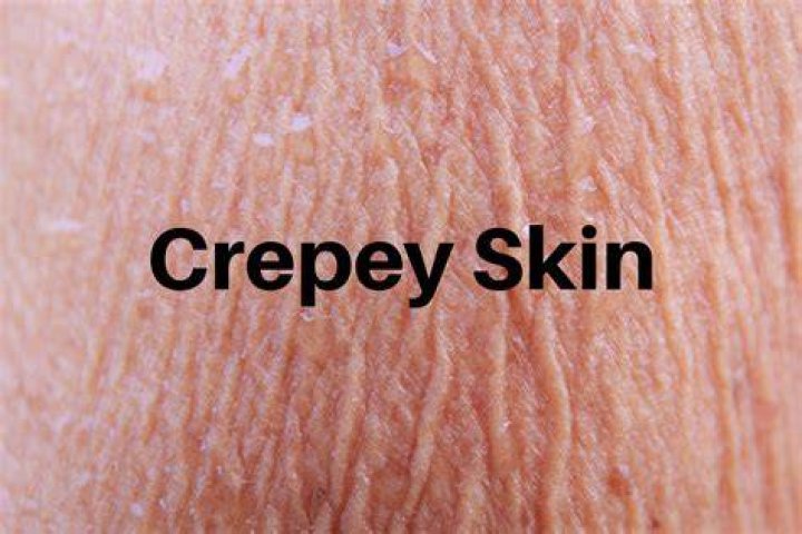 When does crepey skin start?