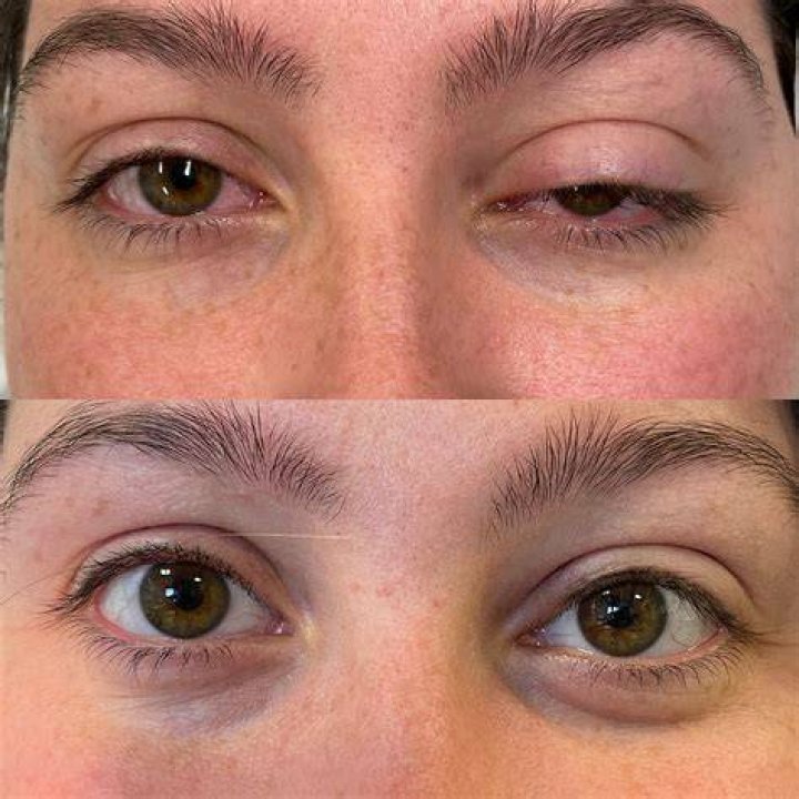When does eyelid droop after botox?