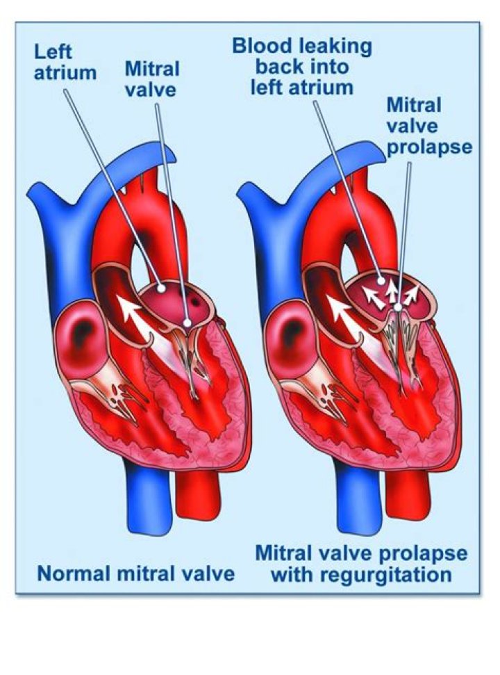 When does mitral valve prolapse occur?