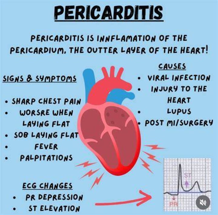 When is pericarditis serious?