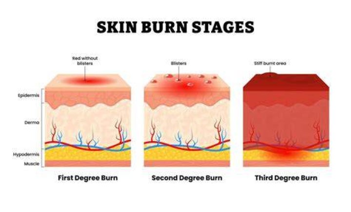 When treating a third degree burn?