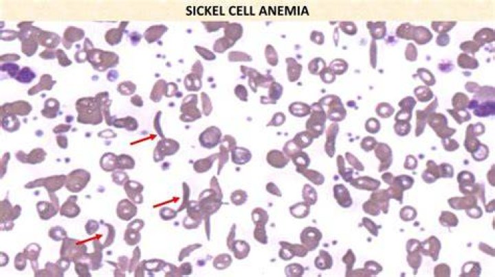 Which codon in the sickle cell dna is altered?