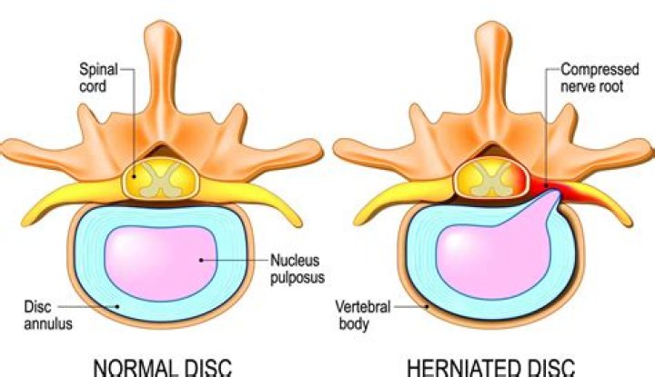 Why are intervertebral discs so strong?