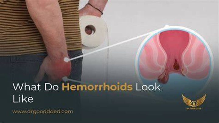 Why do hemorrhoids cause tenesmus?