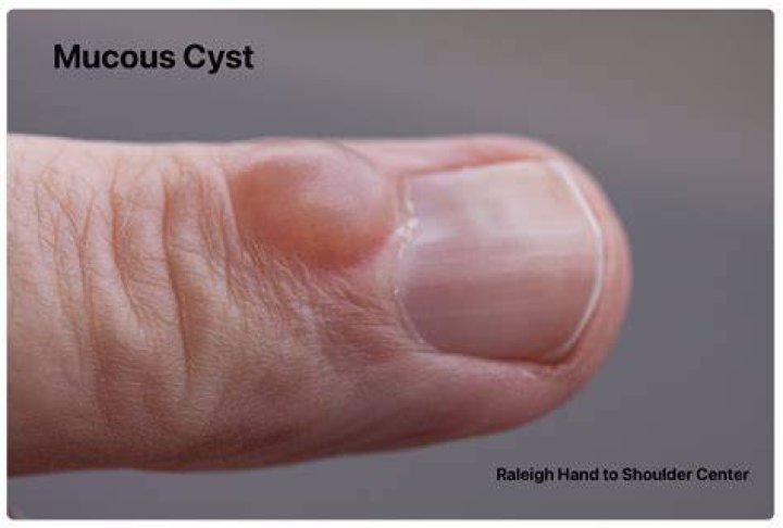 Why do mucous cysts form?