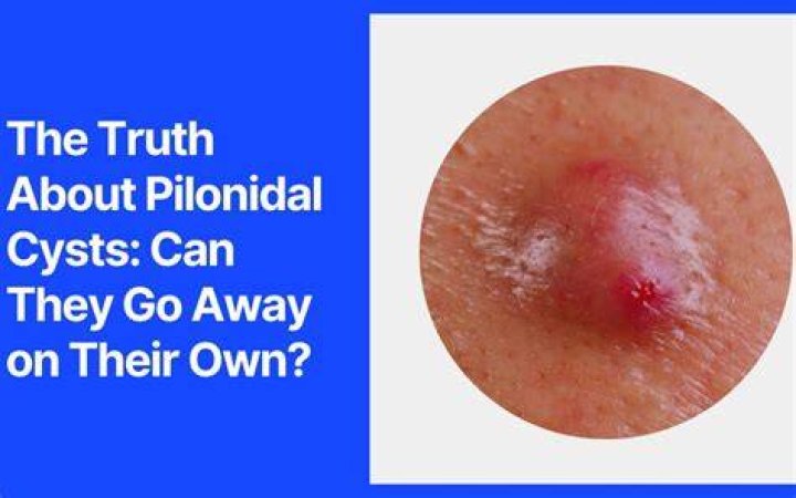 Why pilonidal cyst happen?