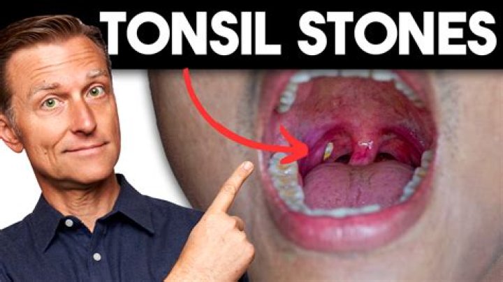 Will they remove tonsils for tonsil stones?