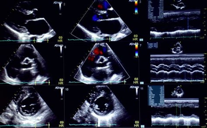 Would an echocardiogram show blockages?